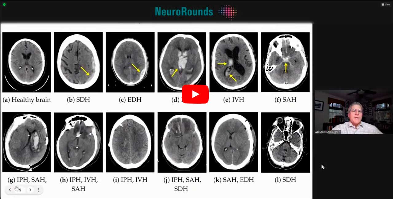 All about brain bleeds mark r mclaughlin md
